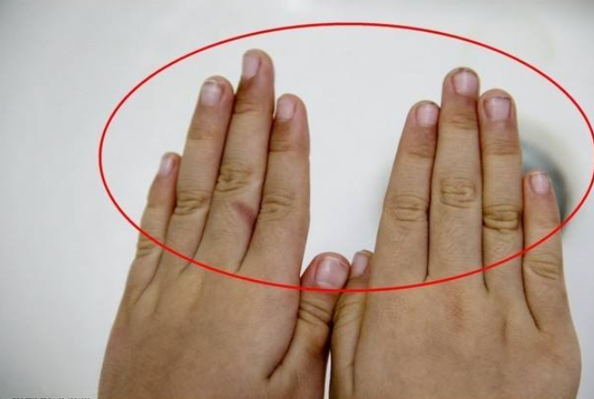 杵状指,顾名思义,就是手指或脚趾末端出现增生肥厚,末端比较肥大并且