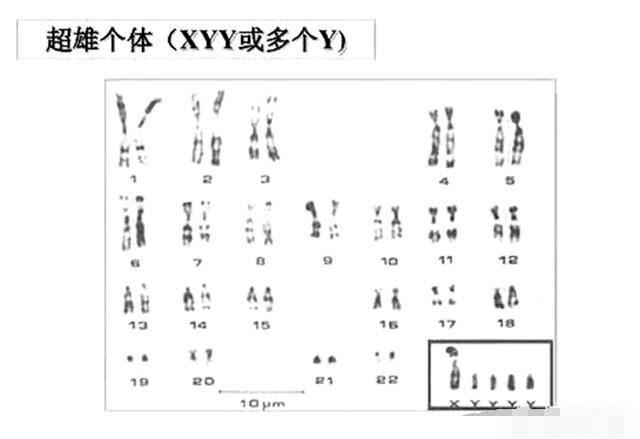 男人的染色体是xy,女人是xx,那染色体是yy的人会是什么样子?