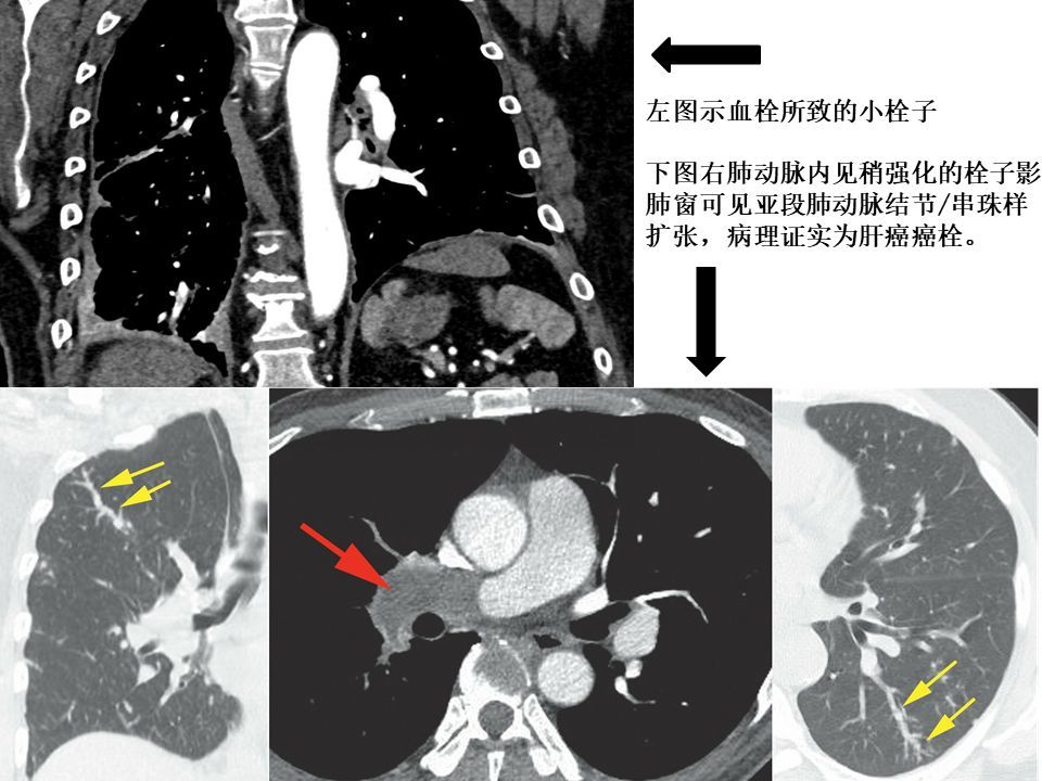 肺栓塞 ct 不会读?看完这篇文章轻松入门!