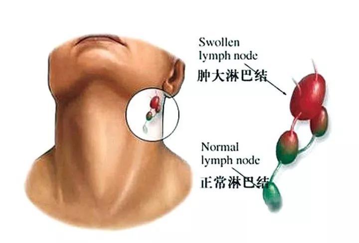 阿sa蔡卓妍淋巴结肿大?淋巴结肿大=得癌?