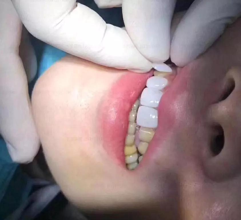 相对于传统美牙方式,新型牙齿贴面技术的优势在哪里?