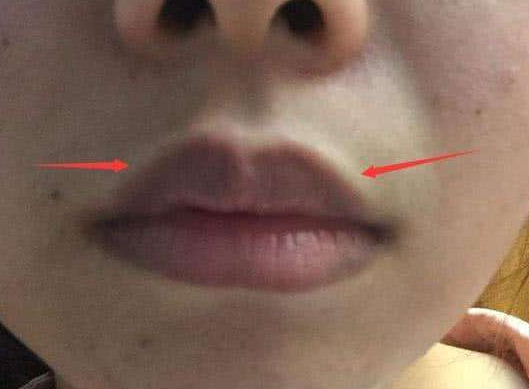 嘴唇发黑通常有几个重要的原因,第一是因为身体缺乏维生素,导致嘴唇