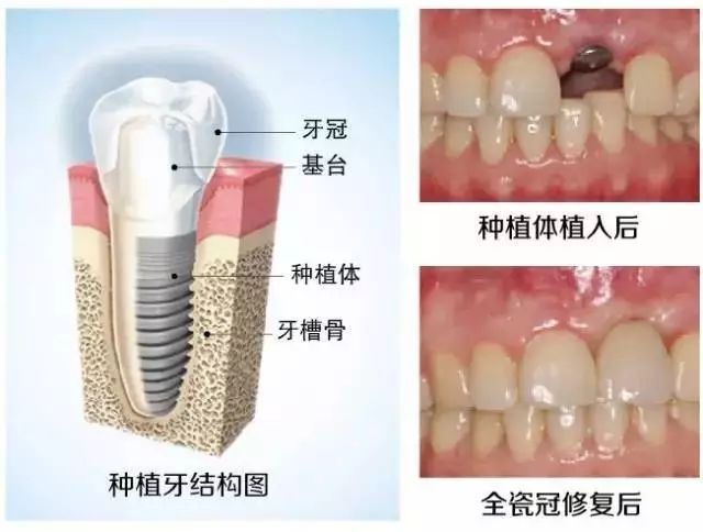 医生,为什么镶一颗牙齿,还要磨两边的牙?