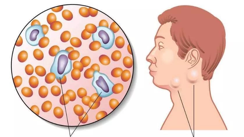 淋巴结向你发出求救信号!