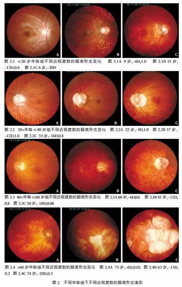 近视600度以上的眼底图片,看完深思,你离高度近视有多远?