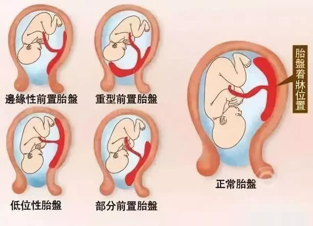 胎盘低置状态怎样让它涨上去?