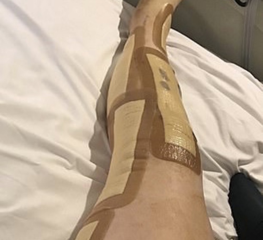 左腿断裂,骨折,脱臼,罕见疾病
