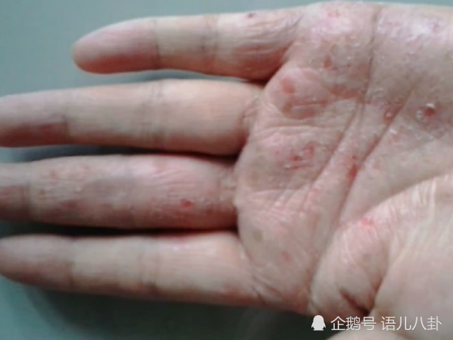 肝癌,癌症,瘙痒,肝脏