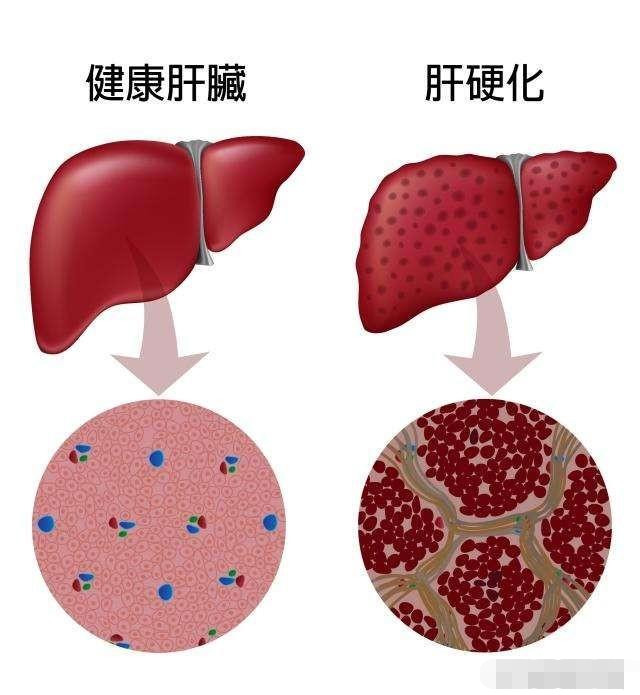 肝硬化,会发出"1痒,2黄,3舌"的肝脏求救信号,具体是什么症状呢?