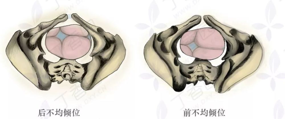 胎头矢状缝虽然在骨盆横径上,但是偏后,胎头侧屈严重时,矢状缝可