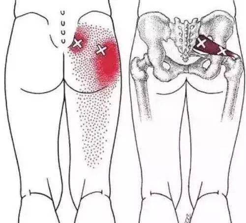 梨状肌综合征,跑步,臀部,屁股疼,久坐