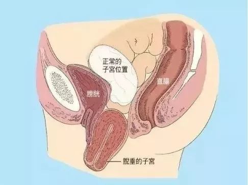 子宫内翻的发病率只有为1/50000,罕见又凶险,相当于产妇把子宫生出来