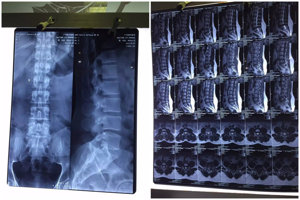 腰椎骨质增生,椎体滑脱的针刀治法