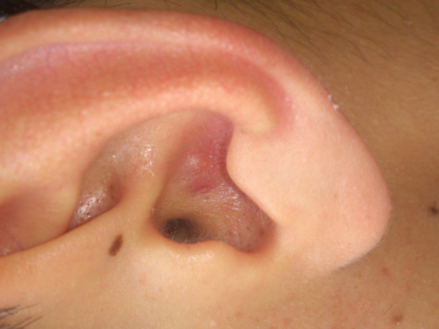 3.油耳朵