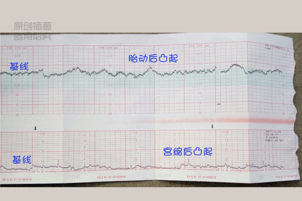 "胎心监护图"是什么?做它对身体有害吗?你会看吗?全都
