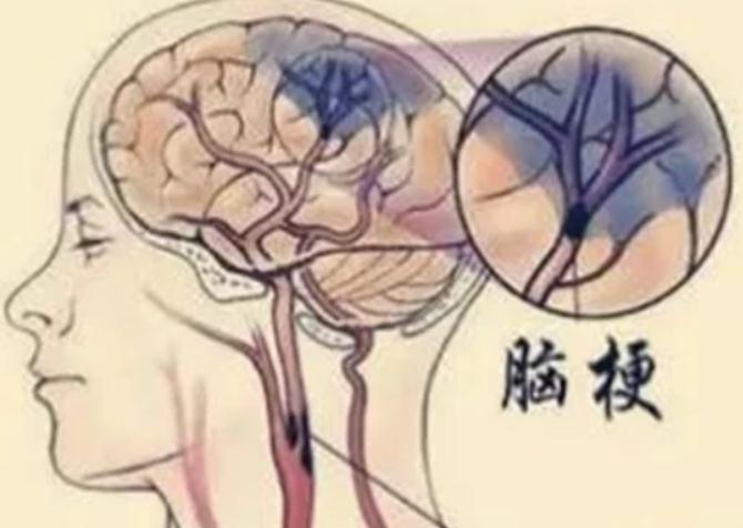 这是十分危险的一种疾病,所以要了解脑梗的症状,能够早发现早治疗,对