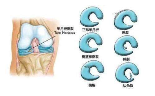 半月板撕裂类型 常见半月板损伤主要就是:半月板撕裂.