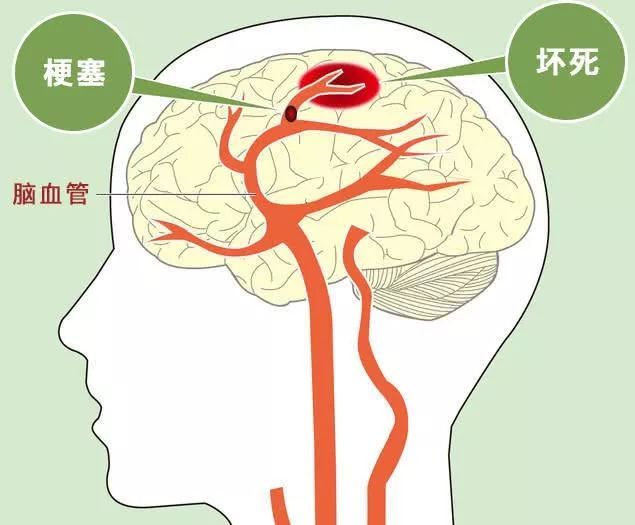 发现"腔梗"怎么办?坚持3件事,不让"腔梗"变"脑梗"