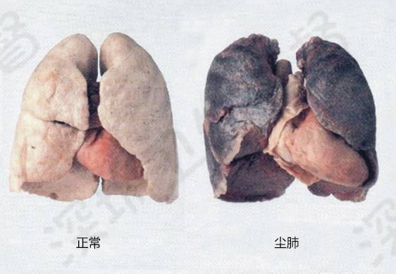 01 什么是尘肺病 患者由于长期接触生产性粉尘,使呼吸系统的防御机能