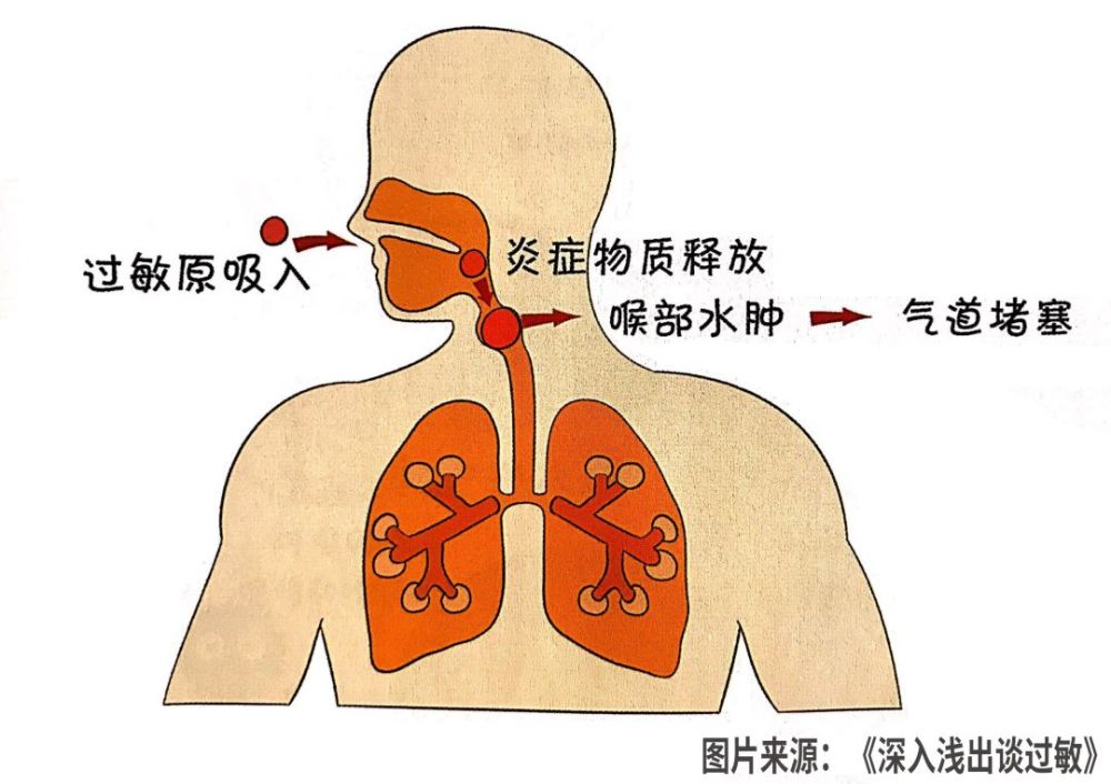 令人窒息的过敏性喉头水肿