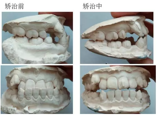 进入跳咬合阶段 患者存在反颌或锁颌问题,随着矫治的进行,进入跳