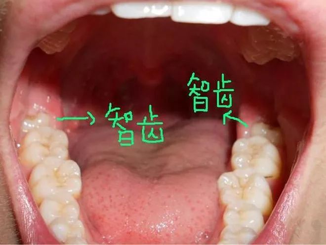 拔智齿的最佳年龄是什么时候?