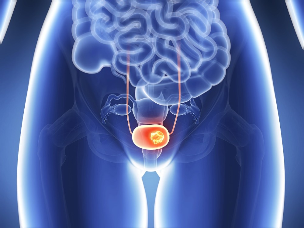 膀胱结石的症状表现主要是哪些