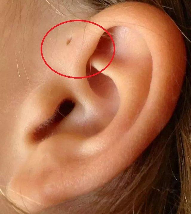 孩子耳朵上的小孔,是福气的象征?"耳前瘘管"有多少妈妈不知道