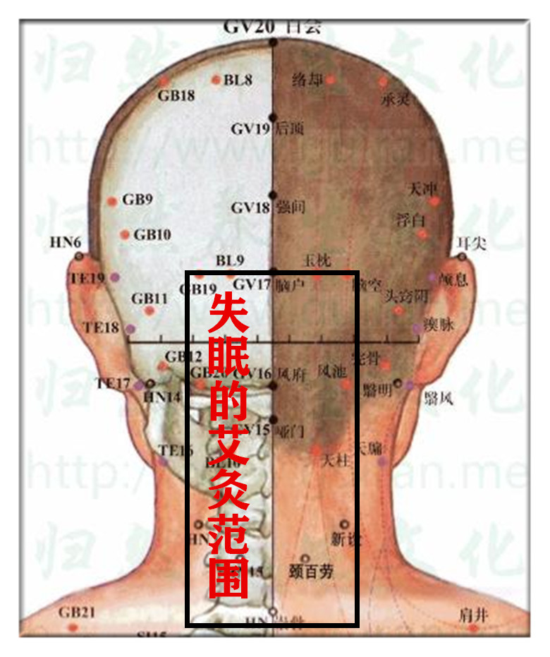 突然连续几天失眠,原因不明,可以试试颈部"大剂量"艾灸 滕州妙手徐