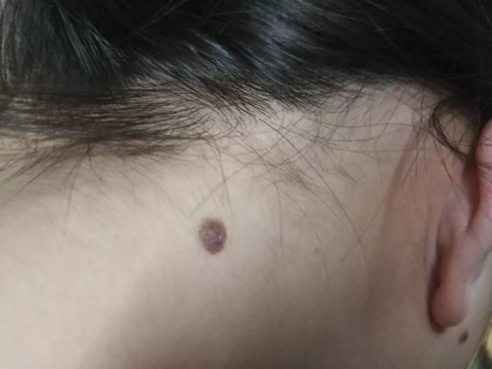 你身上的黑痣该不该"点"?