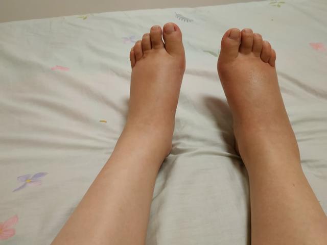尿酸高不高,手脚会告知:手脚4个异常占一半,痛风来报道