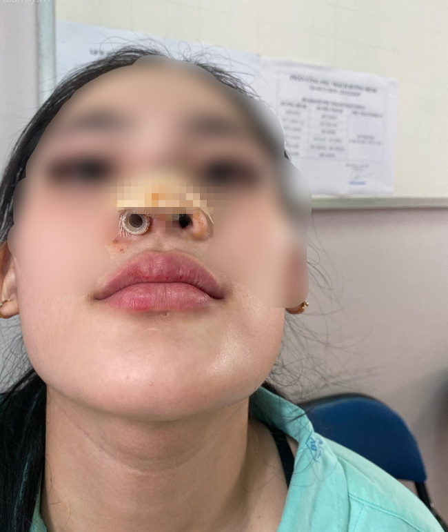 16岁女孩去美容院咨询变美方法被劝隆鼻,术后鼻子变形