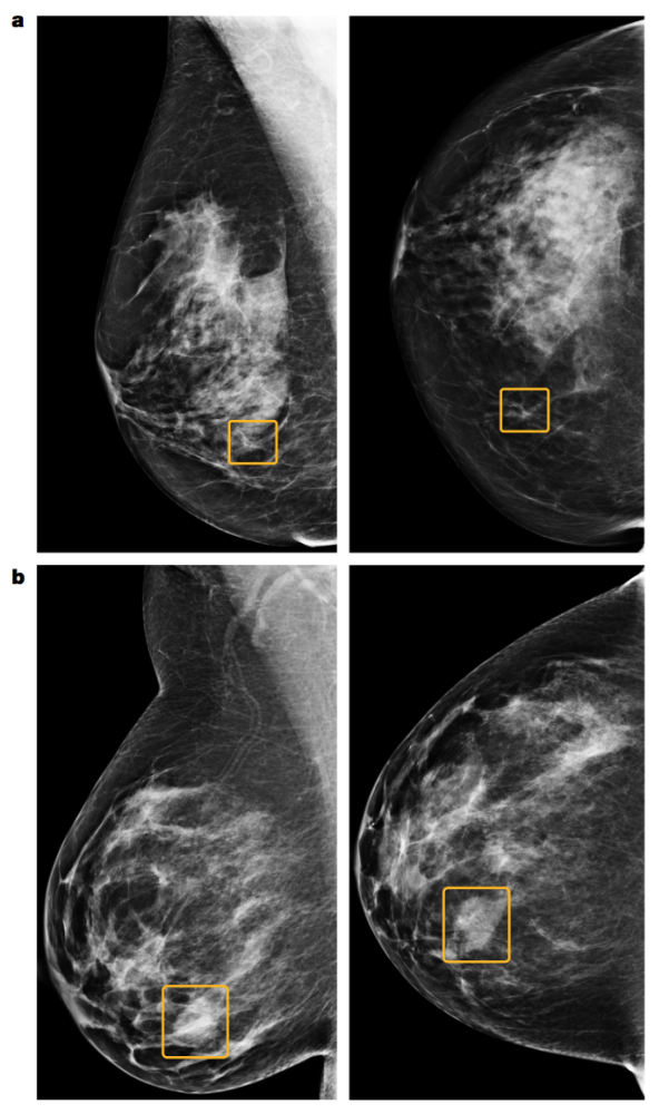 《自然》刊登谷歌新成果:让ai看x光片,提升乳腺癌筛查
