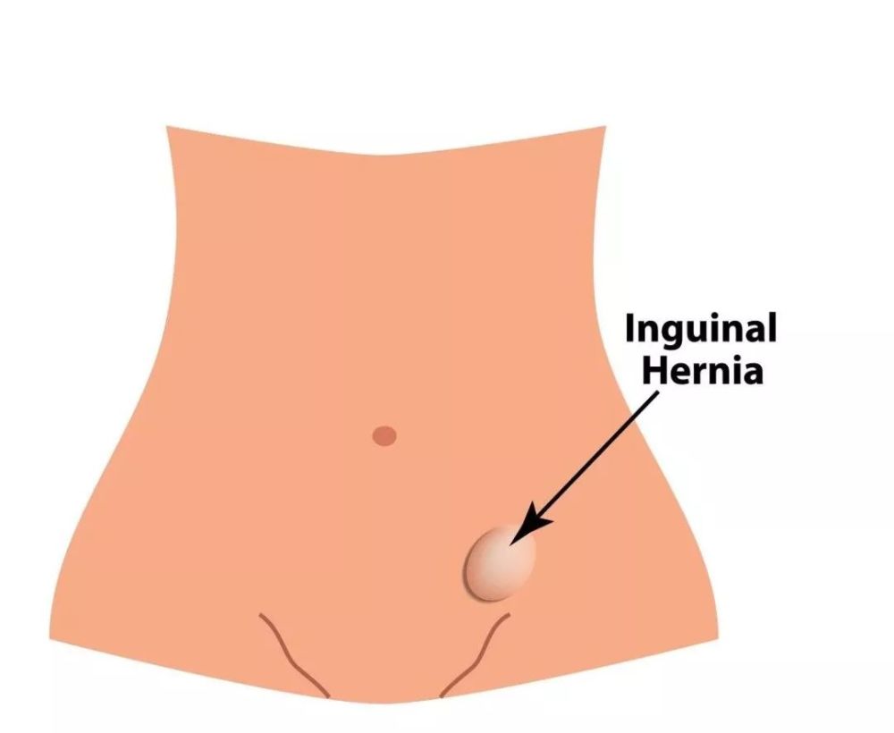 成年人不容易,治愈腹股沟疝有且只有1种方法