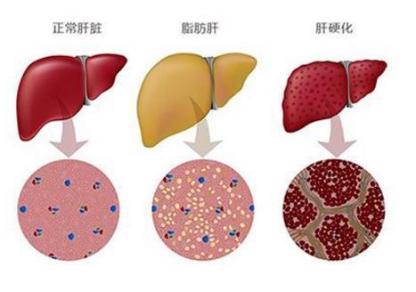 消化内科医生:乙肝,脂肪肝,酒精肝,药物肝,肝癌,一次说个够