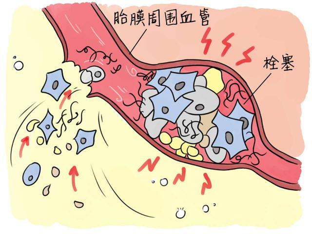 让人闻风丧胆的"羊水栓塞",到底是怎么回事?孕期该如何预防