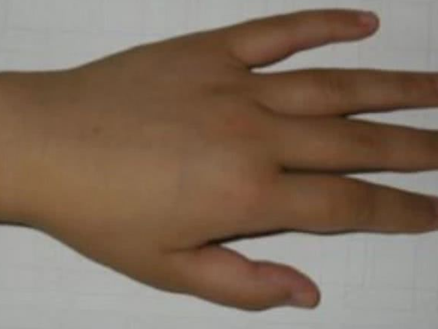 肾脏8成已"超负荷",别拖致尿毒症 若你发现自己的手指上面长出一种软