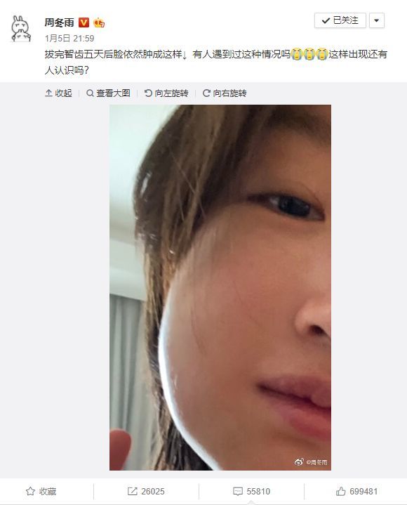 周冬雨拔智齿,脸肿成了表情包!关于拔智齿你一定要知道的事!