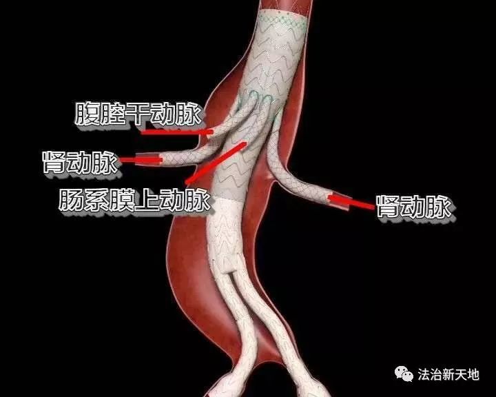 动脉瘤,腹主动脉瘤,动脉,大连医科大学,肠系膜