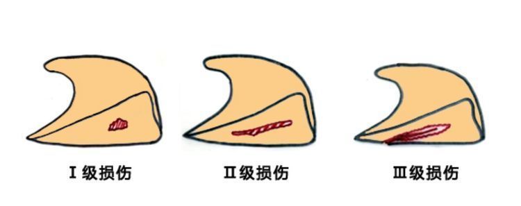 半月板损伤的表现-半月板损伤的术后护理知识