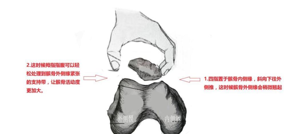 双膝疼痛10年,病根原来是这块小小髌骨