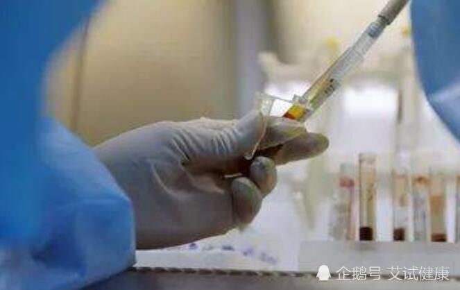 告诉你一招判定艾滋病感染