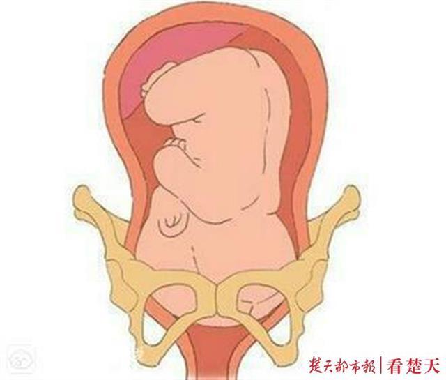 耻骨分离痛让新妈妈只能 倒着走 中医手法3分钟成功复位 企业头条 天眼查