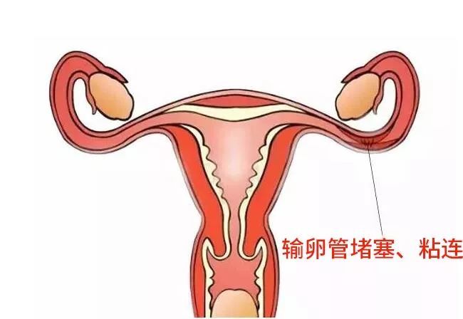 输卵管粘连,如何找回好孕?