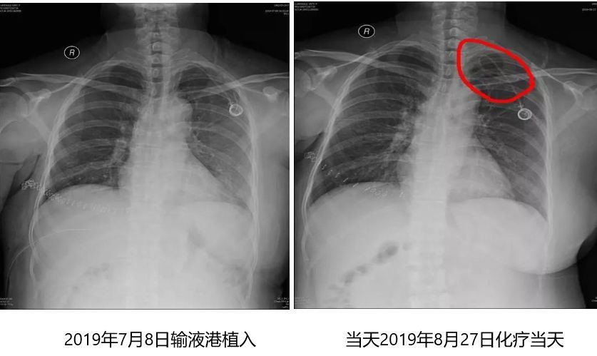 输液港堵管,切莫上来就溶栓,转发提醒所有医护