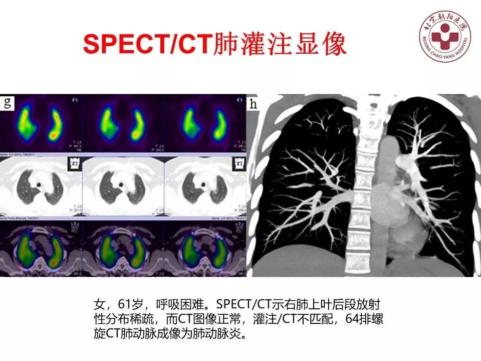 《肺通气-灌注spect/ct显像评价肺动脉栓塞》