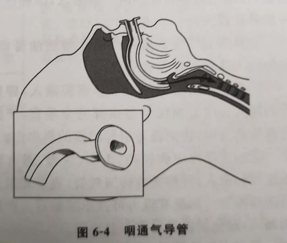 口咽通气导管:口咽通气导管外观呈s形,可以使舌离开咽后壁(图6-4).