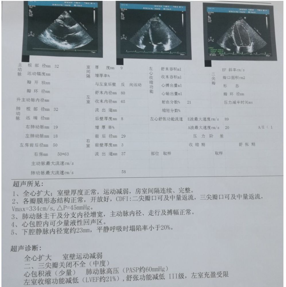 图2患者入院心脏超声检查结果