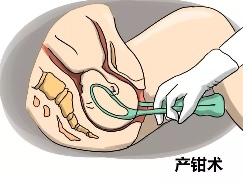 如何避免使用产钳助产?