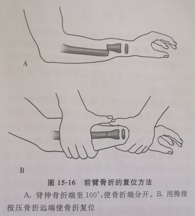 尺骨骨折多伴有上尺桡关节的分离移位(孟氏骨折,monteggia lesion)